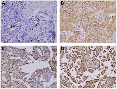 Prognostic Significance of Galectin-1 but Not Galectin-3 in Patients With Lung Adenocarcinoma After Radiation Therapy